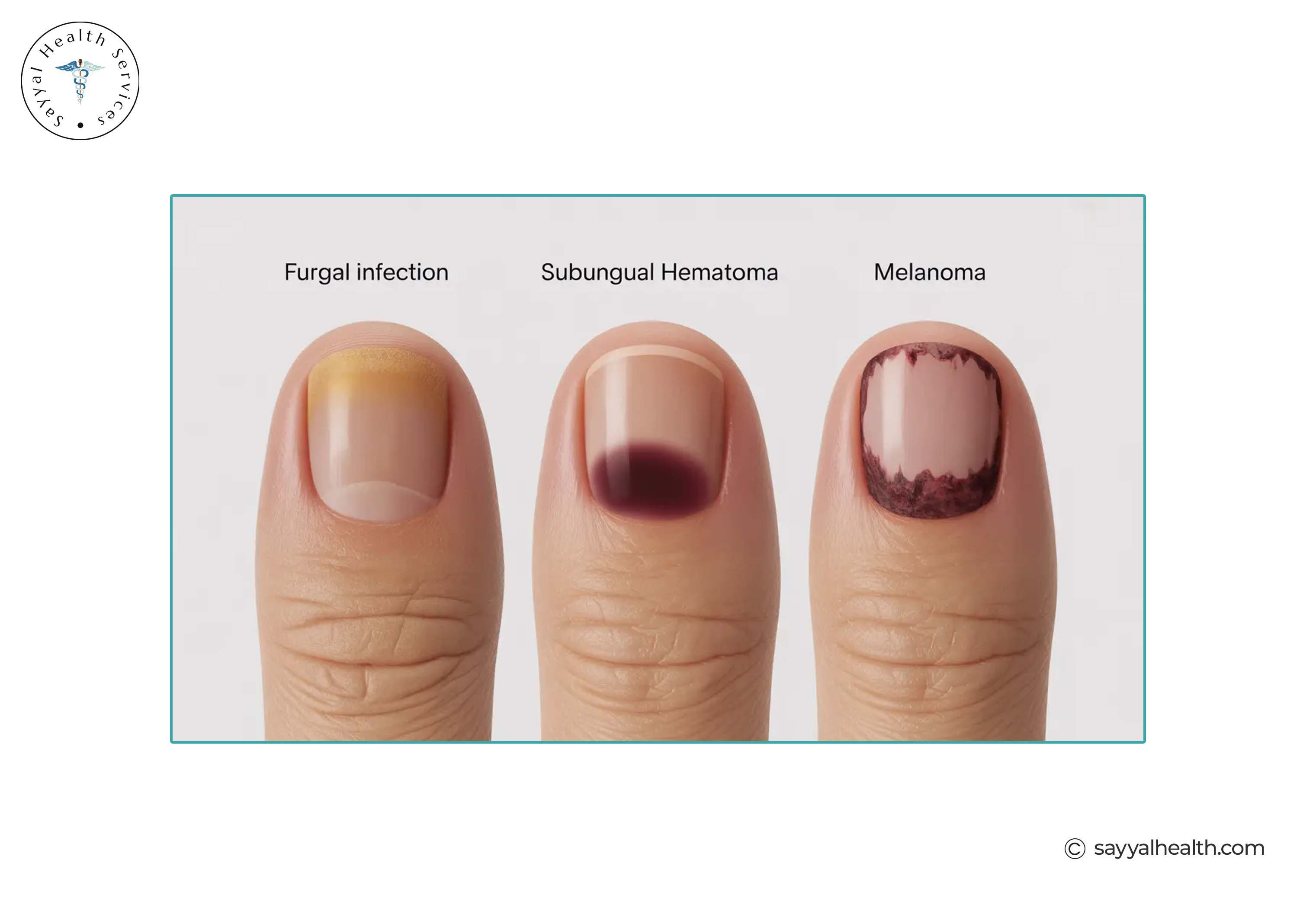 Comparison of fungal infection, subungual hematoma, and melanoma on fingernails